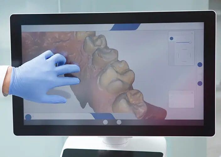 3D Intraoral Scanning
