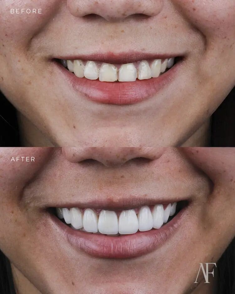 Cosmetic Veneers and Crowns