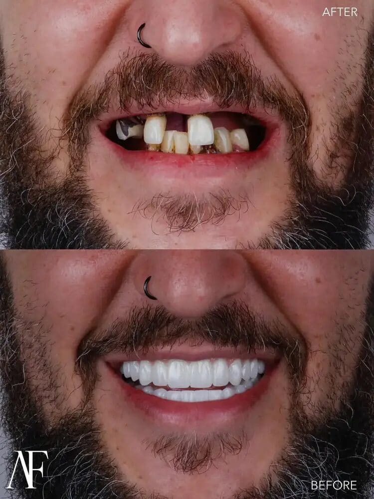 Full-Arch Zirconia Bars